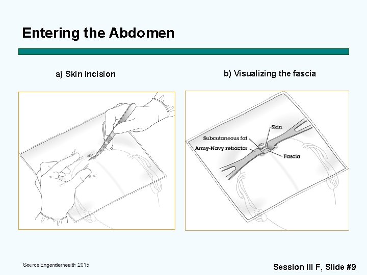 Entering the Abdomen a) Skin incision b) Visualizing the fascia Session III F, Slide
