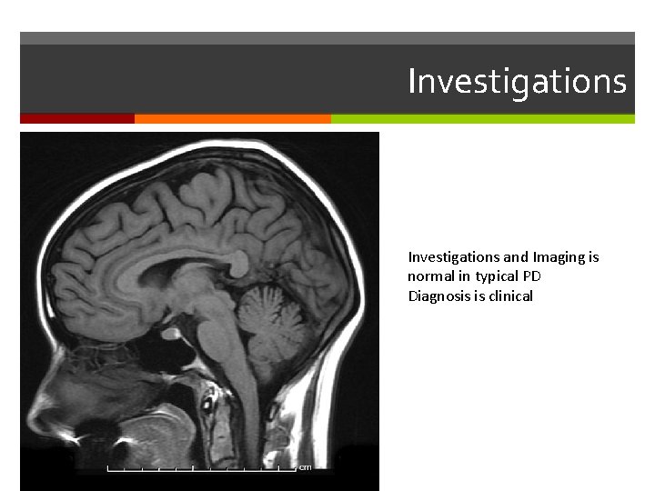 Investigations and Imaging is normal in typical PD Diagnosis is clinical 