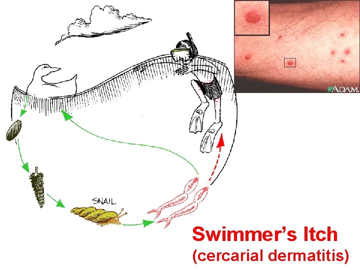 Swimmer’s Itch (cercarial dermatitis) 