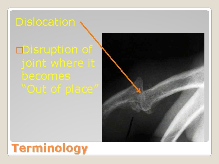 Dislocation �Disruption of joint where it becomes “Out of place” Terminology 