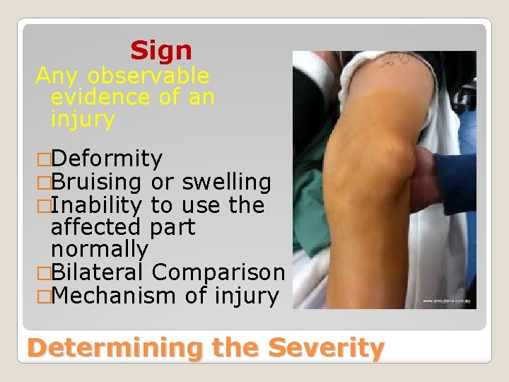 Sign Any observable evidence of an injury �Deformity �Bruising or �Inability to swelling use
