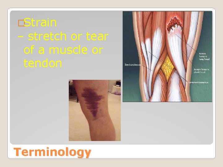 �Strain – stretch or tear of a muscle or tendon Terminology 