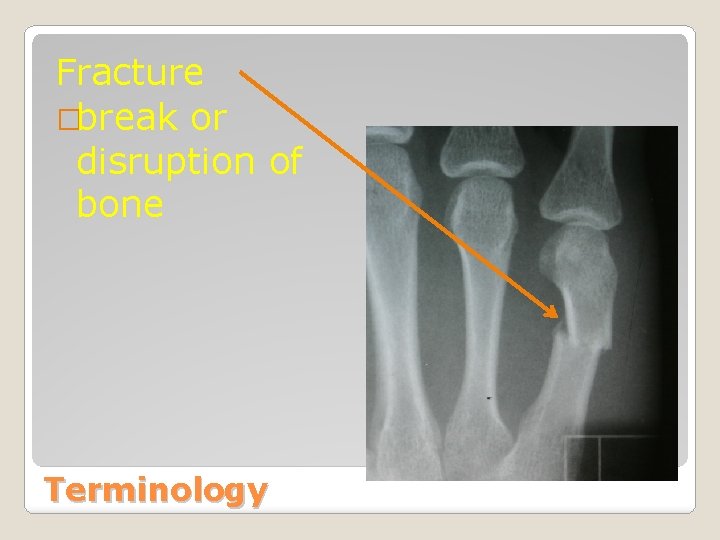 Fracture �break or disruption of bone Terminology 
