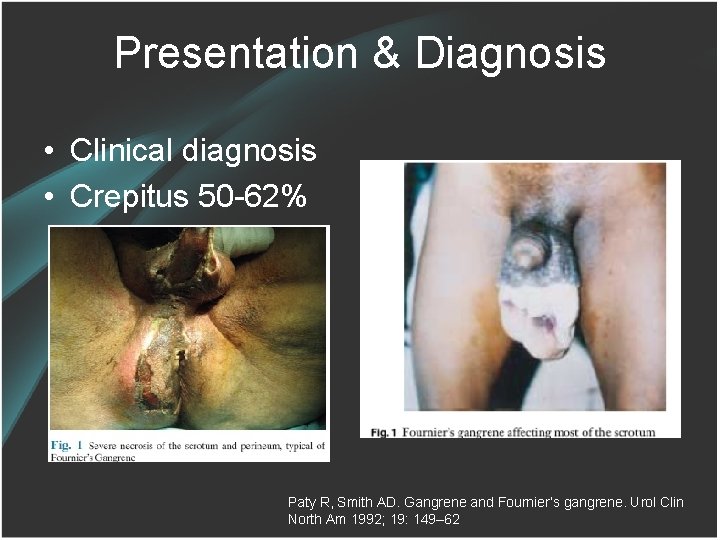 Presentation & Diagnosis • Clinical diagnosis • Crepitus 50 -62% Paty R, Smith AD.