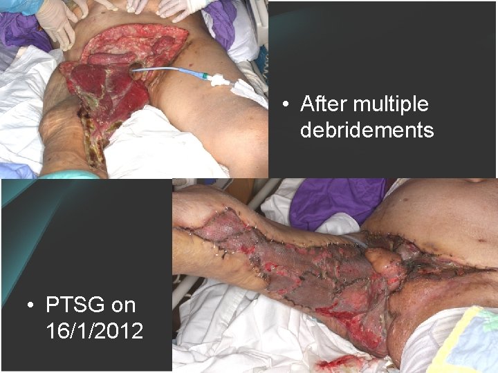  • After multiple debridements • PTSG on 16/1/2012 