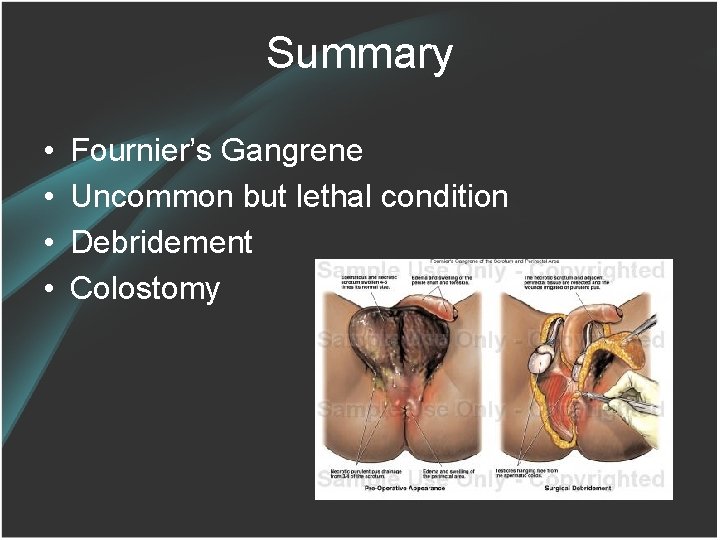 Summary • • Fournier’s Gangrene Uncommon but lethal condition Debridement Colostomy 