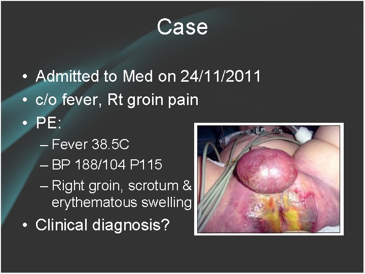 Case • Admitted to Med on 24/11/2011 • c/o fever, Rt groin pain •