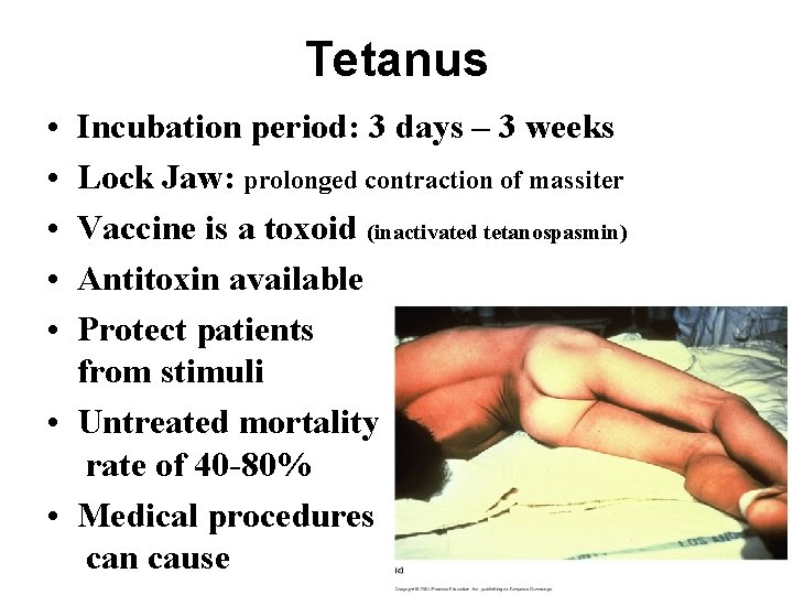 Tetanus • • • Incubation period: 3 days – 3 weeks Lock Jaw: prolonged