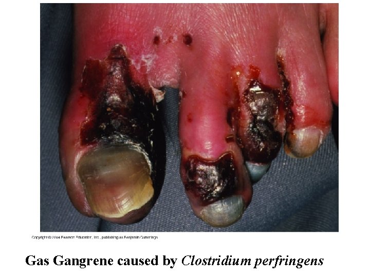 Gas Gangrene caused by Clostridium perfringens 