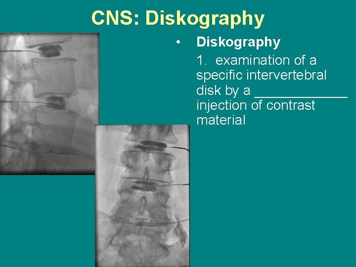 CNS: Diskography • Diskography 1. examination of a specific intervertebral disk by a ______