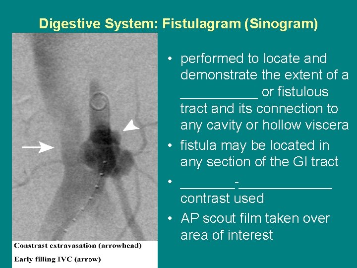 Digestive System: Fistulagram (Sinogram) • performed to locate and demonstrate the extent of a