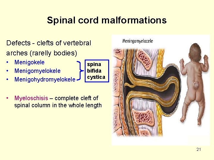 Spinal cord malformations Defects - clefts of vertebral arches (rarelly bodies) • Menigokele •