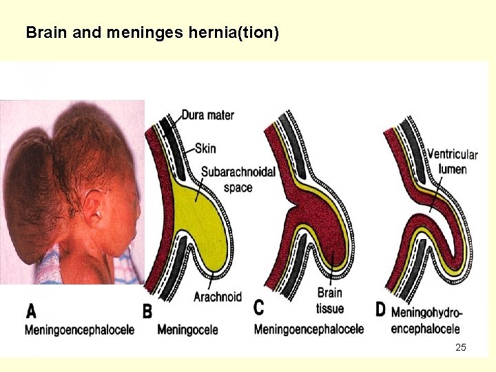 Brain and meninges hernia(tion) 25 