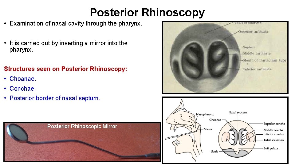 Posterior Rhinoscopy • Examination of nasal cavity through the pharynx. • It is carried