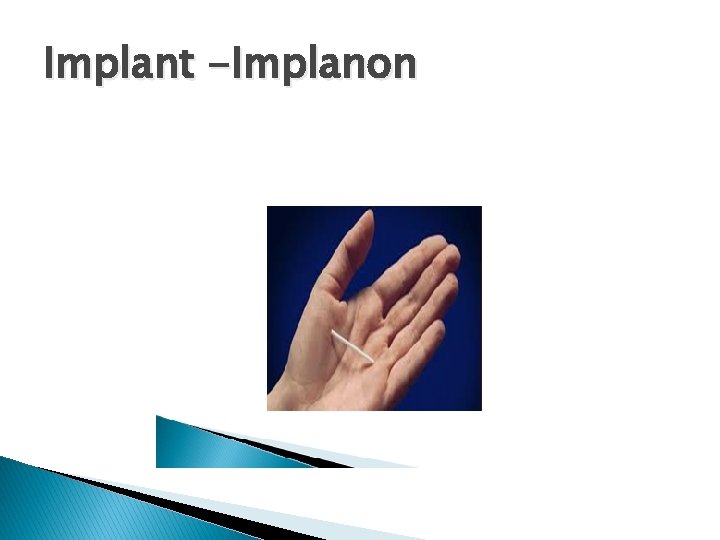 Implant -Implanon 