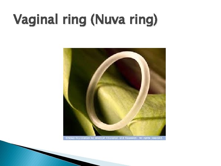 Vaginal ring (Nuva ring) 