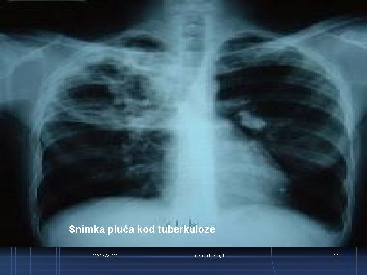 Snimka pluća kod tuberkuloze 12/17/2021 alen vukelić, dr 14 