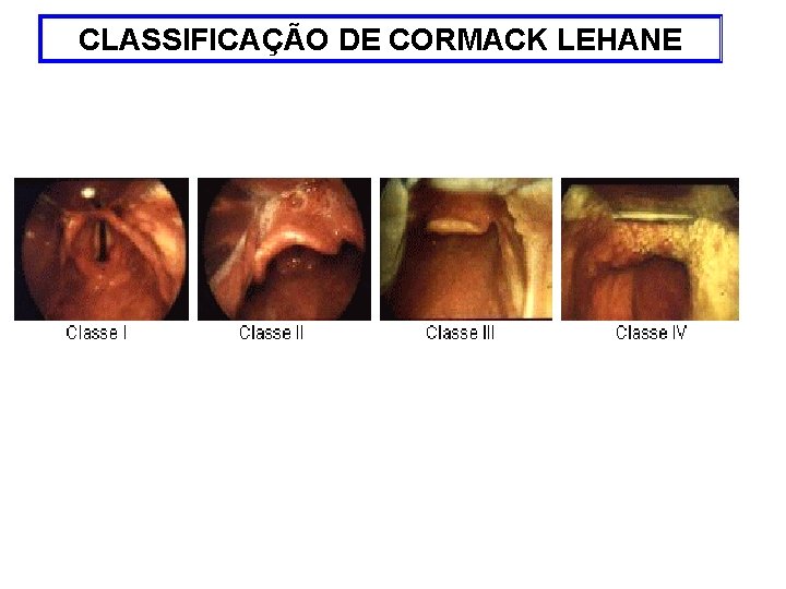 CLASSIFICAÇÃO DE CORMACK LEHANE 