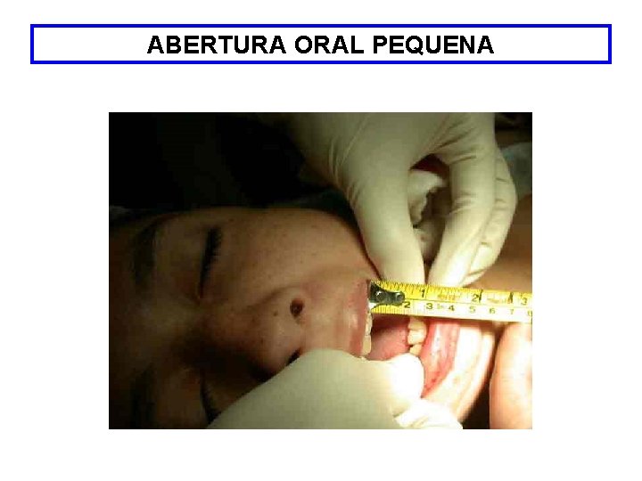 ABERTURA ORAL PEQUENA 