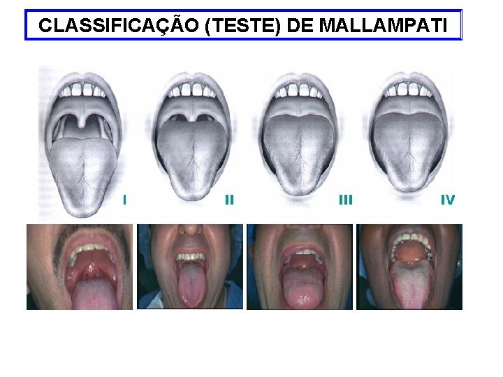CLASSIFICAÇÃO (TESTE) DE MALLAMPATI 