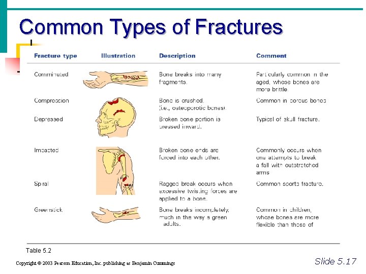 Common Types of Fractures Table 5. 2 Copyright © 2003 Pearson Education, Inc. publishing