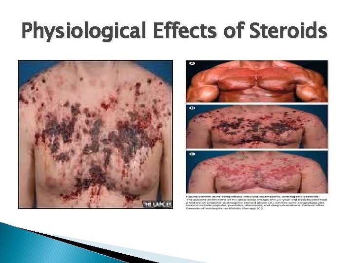 Physiological Effects of Steroids 