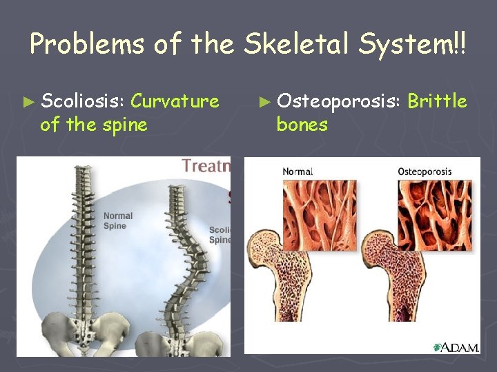 Problems of the Skeletal System!! ► Scoliosis: Curvature of the spine ► Osteoporosis: bones