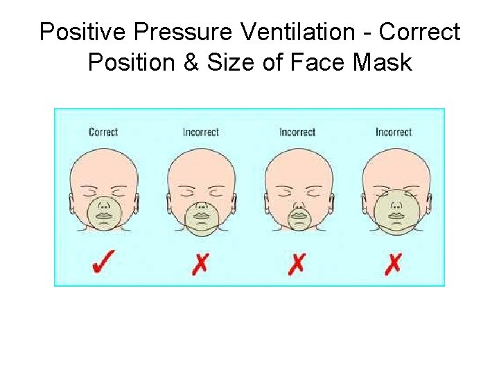 Positive Pressure Ventilation - Correct Position & Size of Face Mask 