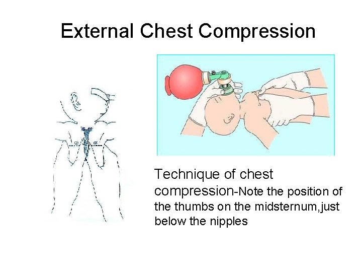 External Chest Compression Technique of chest compression-Note the position of the thumbs on the