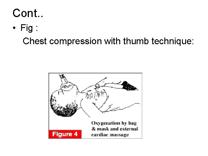 Cont. . • Fig : Chest compression with thumb technique: 