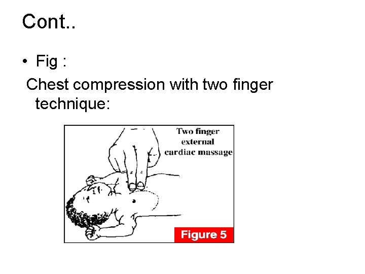 Cont. . • Fig : Chest compression with two finger technique: 