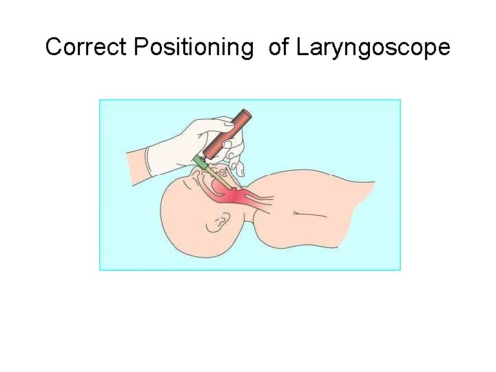 Correct Positioning of Laryngoscope 