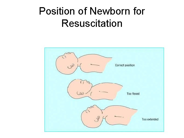 Position of Newborn for Resuscitation 