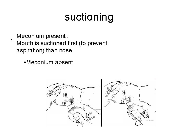 suctioning. Meconium present : Mouth is suctioned first (to prevent aspiration) than nose •