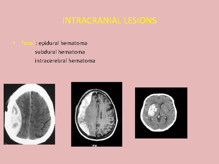 INTRACRANIAL LESIONS • Focal : epidural hematoma subdural hematoma intracerebral hematoma 