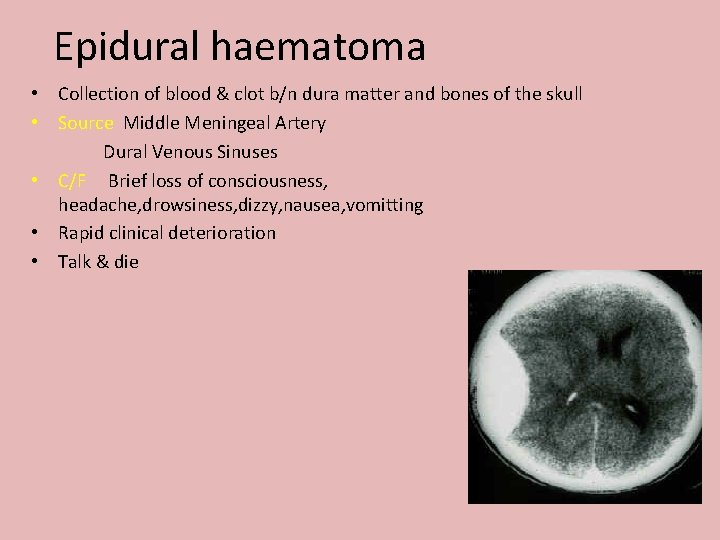 Epidural haematoma • Collection of blood & clot b/n dura matter and bones of