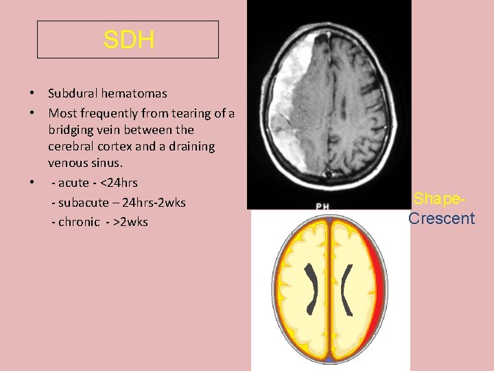 SDH • Subdural hematomas • Most frequently from tearing of a bridging vein between