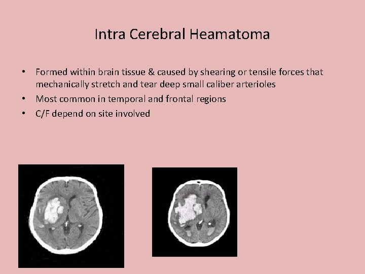 Intra Cerebral Heamatoma • Formed within brain tissue & caused by shearing or tensile