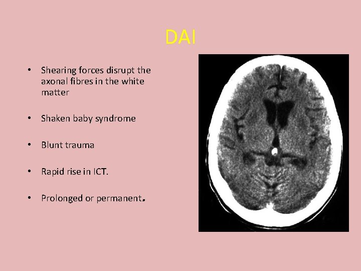 DAI • Shearing forces disrupt the axonal fibres in the white matter • Shaken