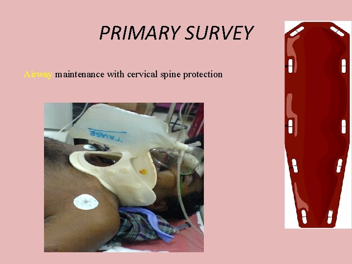 PRIMARY SURVEY Airway maintenance with cervical spine protection 