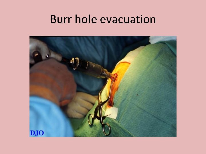 Burr hole evacuation 