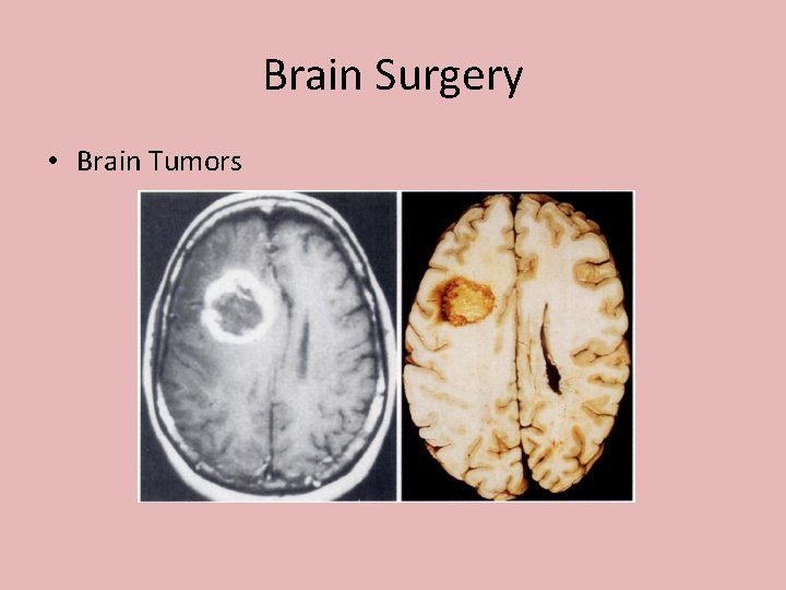 Brain Surgery • Brain Tumors 