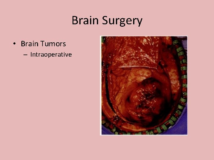 Brain Surgery • Brain Tumors – Intraoperative 