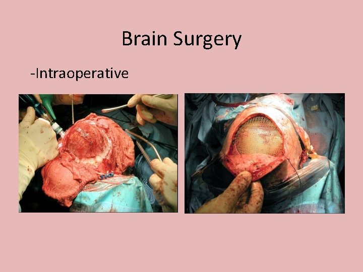 Brain Surgery -Intraoperative 