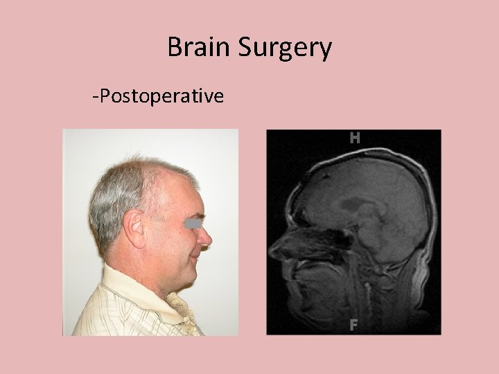 Brain Surgery -Postoperative 