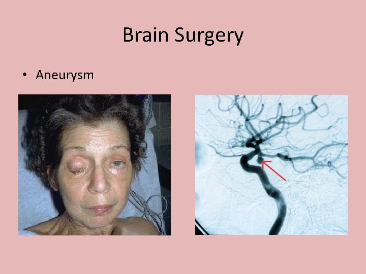 Brain Surgery • Aneurysm 