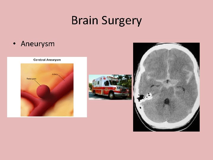 Brain Surgery • Aneurysm 