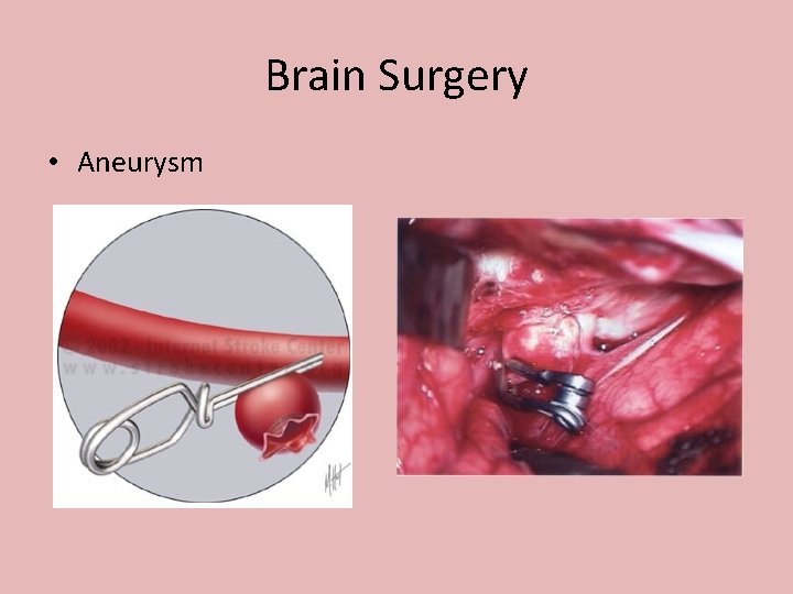 Brain Surgery • Aneurysm 