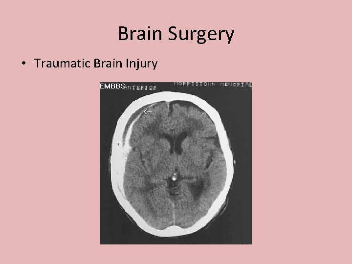 Brain Surgery • Traumatic Brain Injury 