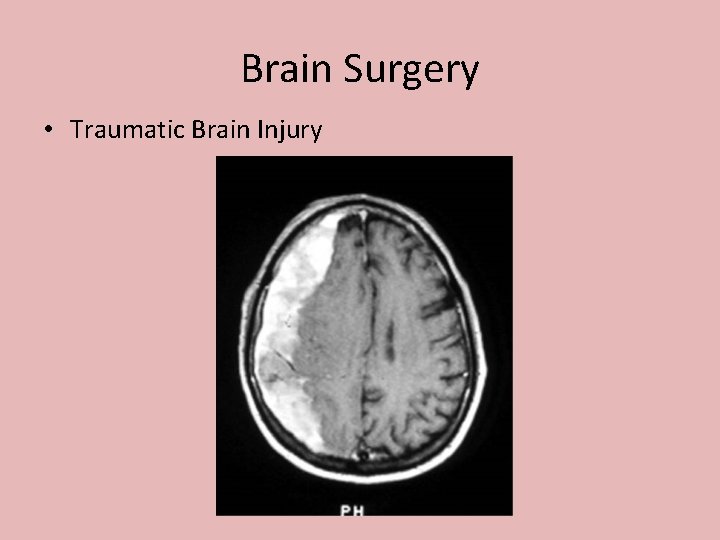 Brain Surgery • Traumatic Brain Injury 